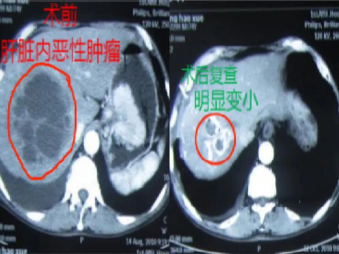 什么是外周介入【新技术】外周疾病找介入   微创高效多优处_https://www.jmylbn.com_新闻资讯_第3张