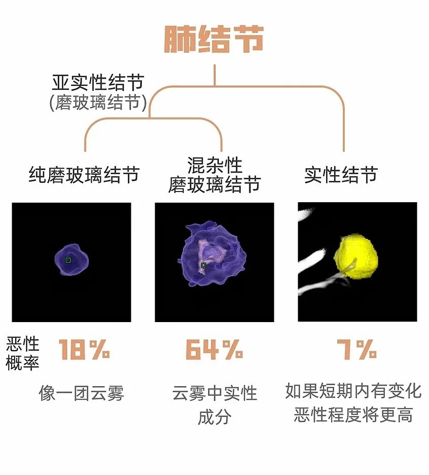 磨玻璃结节 磨玻璃结节