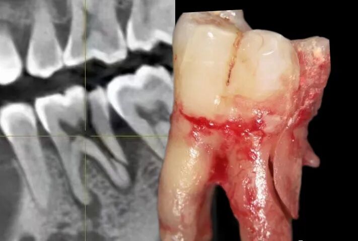 好牙都能咬劈，何况治疗过的牙你还不做冠！