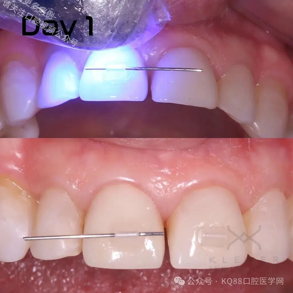 关闭间隙，还能这么干？