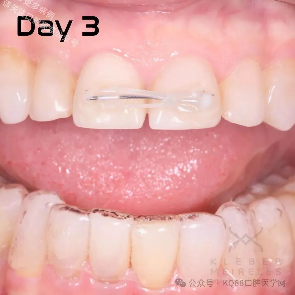 关闭间隙，还能这么干？