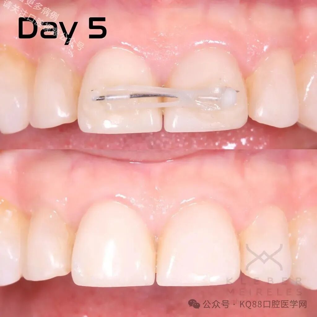 关闭间隙，还能这么干？