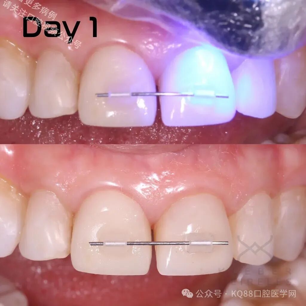 关闭间隙，还能这么干？