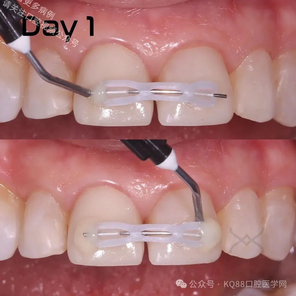 关闭间隙，还能这么干？