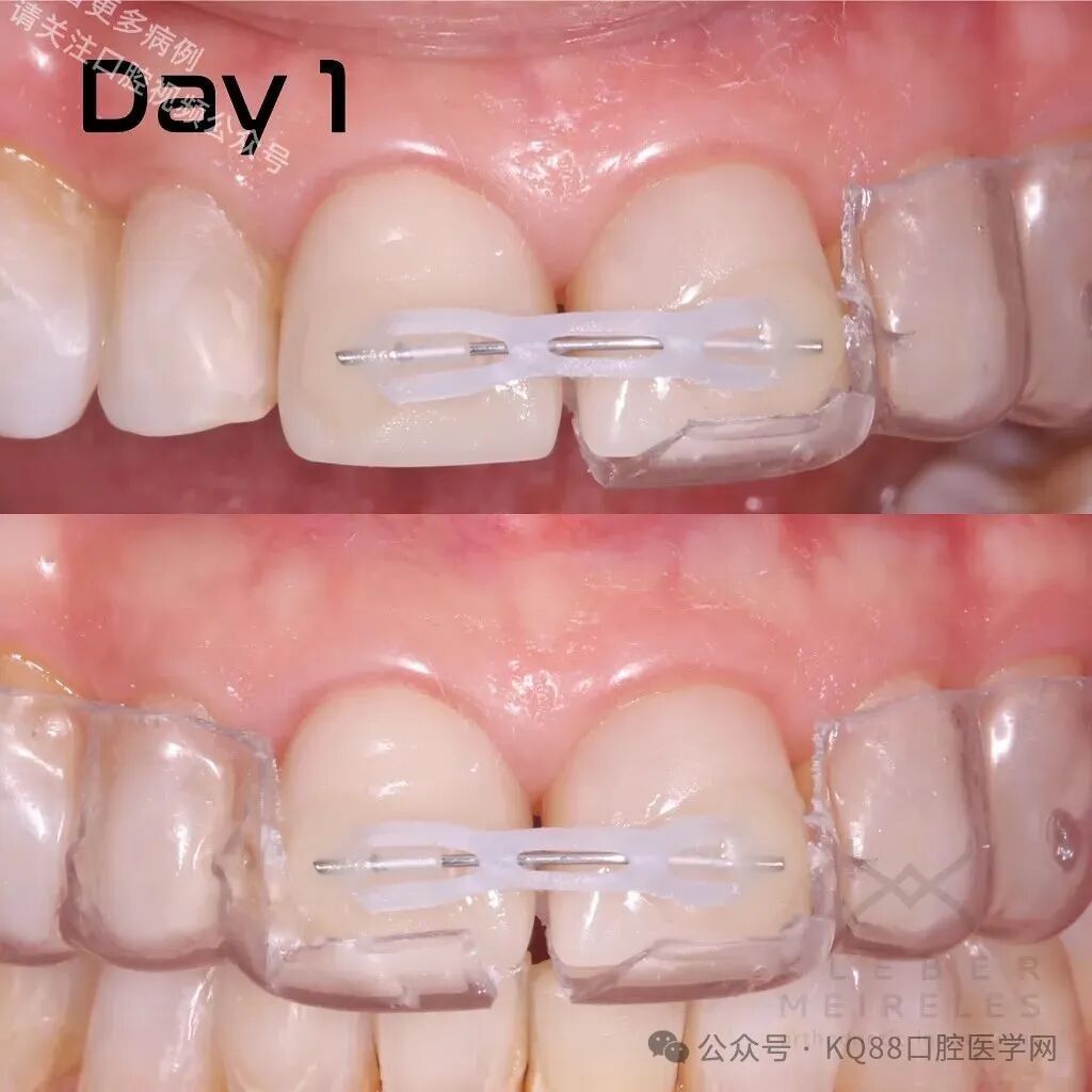 关闭间隙，还能这么干？