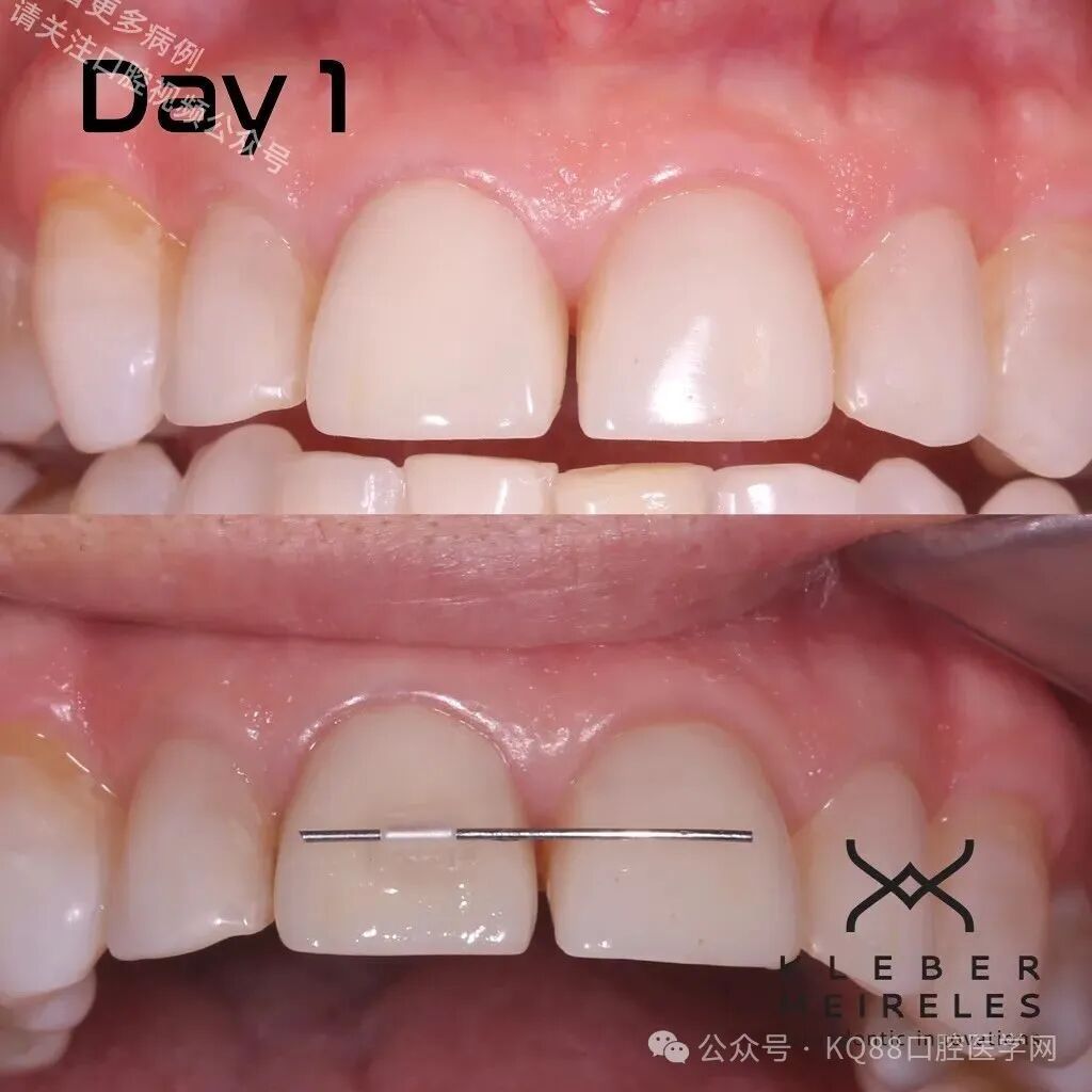 关闭间隙，还能这么干？