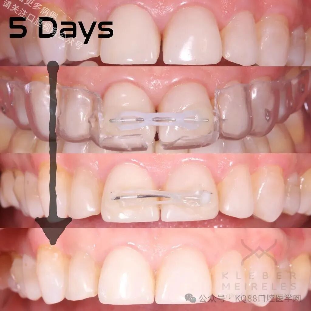 关闭间隙，还能这么干？