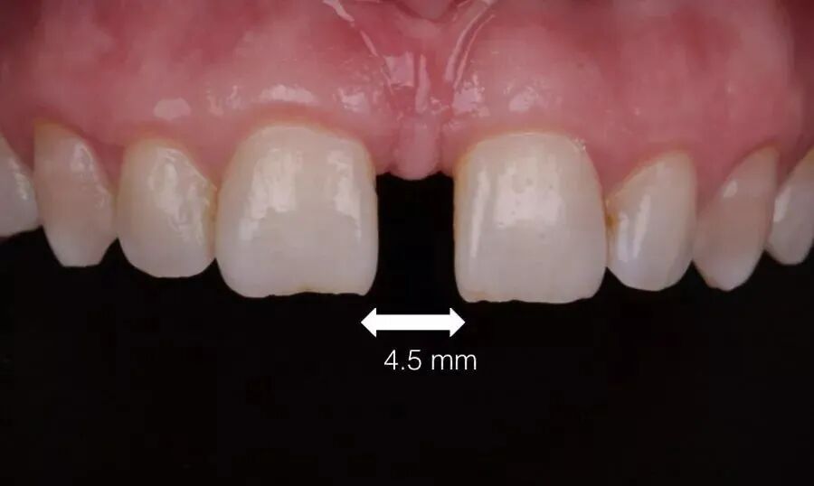 11、21之间存在4.5mm间隙你该如何修复？