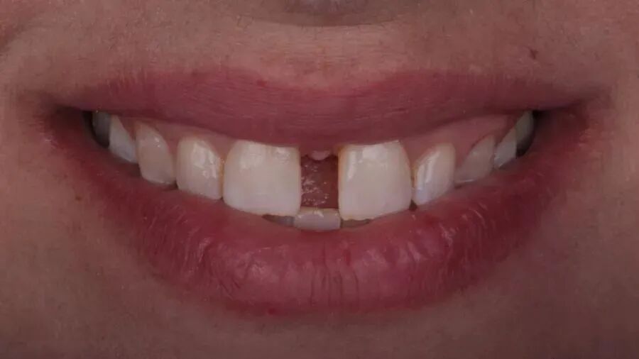 11、21之间存在4.5mm间隙你该如何修复？