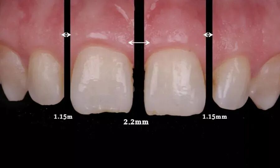 11、21之间存在4.5mm间隙你该如何修复？