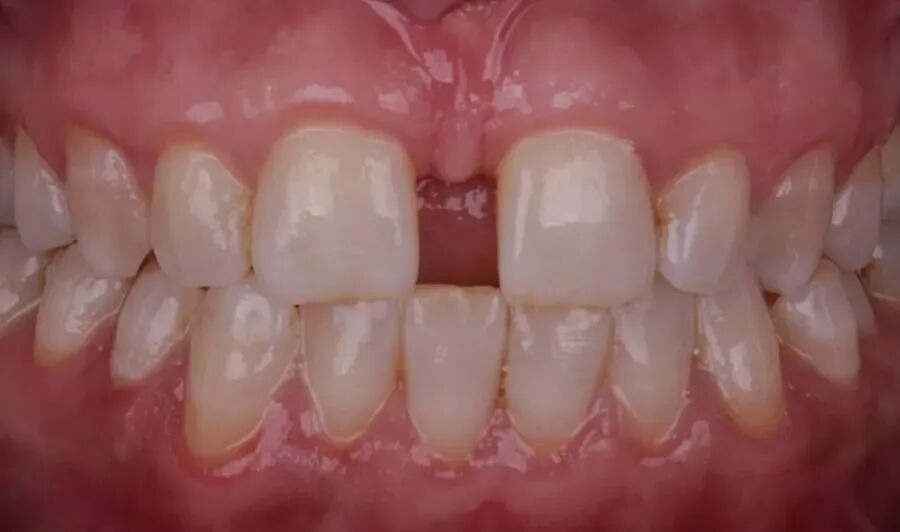 11、21之间存在4.5mm间隙你该如何修复？