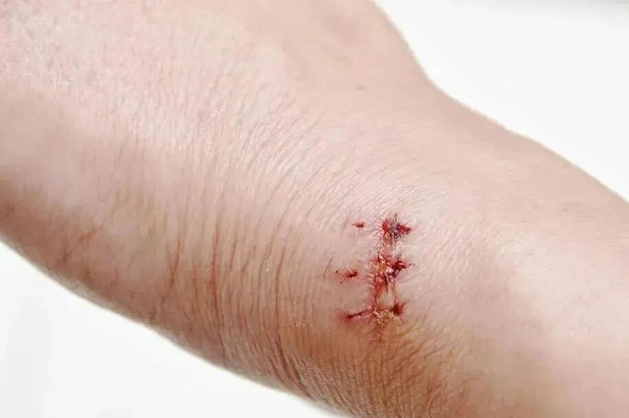 纱布绷带怎么用【健康365】超实用！包扎的正确打开方式，赶紧学起来！_https://www.jmylbn.com_新闻资讯_第35张