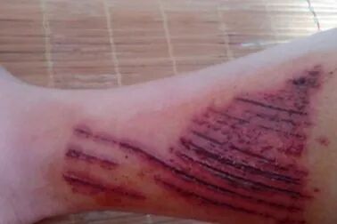 纱布绷带怎么用【健康365】超实用！包扎的正确打开方式，赶紧学起来！_https://www.jmylbn.com_新闻资讯_第38张