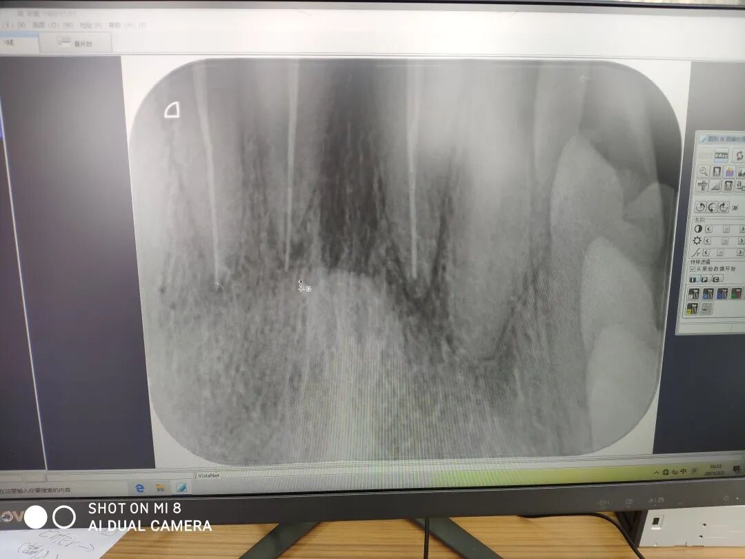 数字牙片机怎么用口腔门诊引进数字化牙片机 让牙齿成像更精准_https://www.jmylbn.com_新闻资讯_第8张