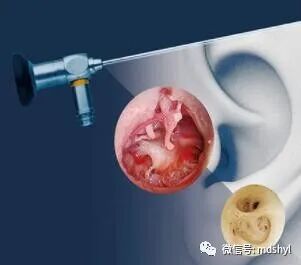 耳鼻喉治疗台怎么消毒麦迪生医疗‖耳鼻喉科相关常用高值耗材大全_https://www.jmylbn.com_新闻资讯_第53张