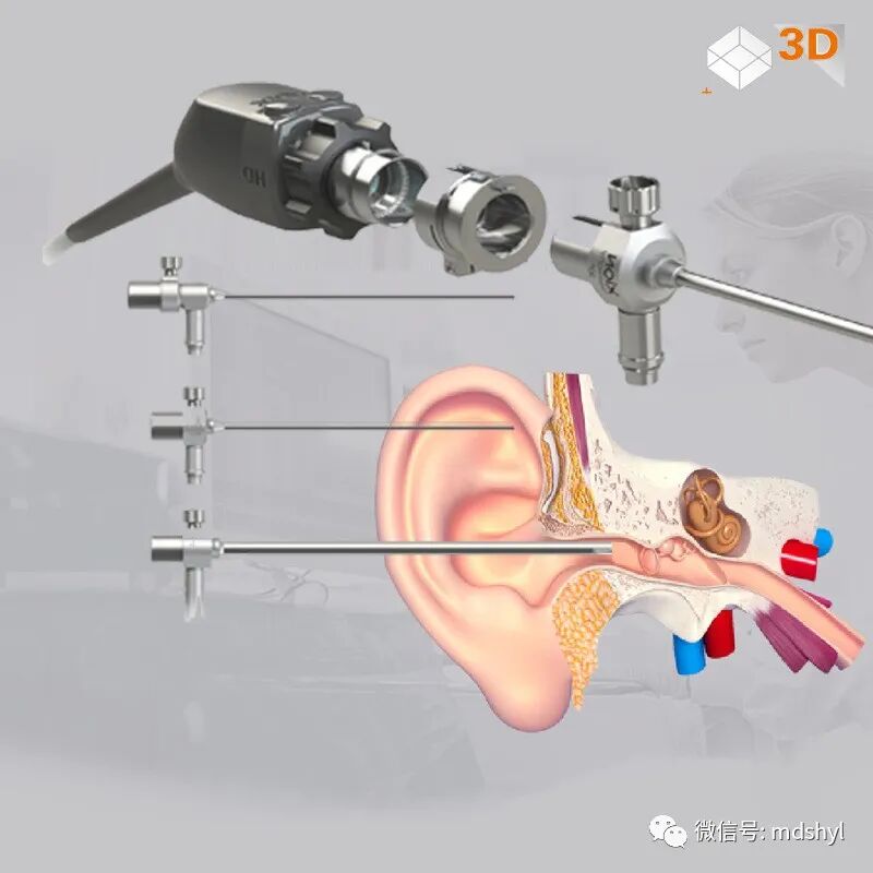 耳鼻喉治疗台怎么消毒麦迪生医疗‖耳鼻喉科相关常用高值耗材大全_https://www.jmylbn.com_新闻资讯_第76张