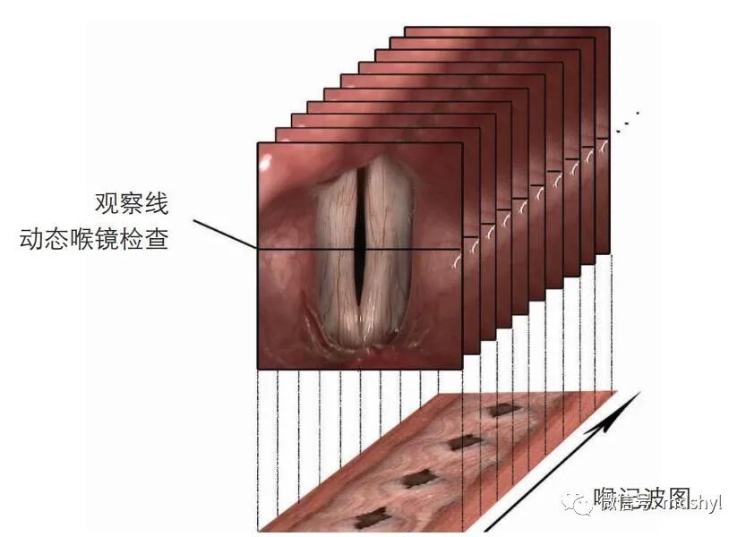普通喉镜怎么使用如何避免动态电子喉镜误当普通电子喉镜使用？_https://www.jmylbn.com_新闻资讯_第30张