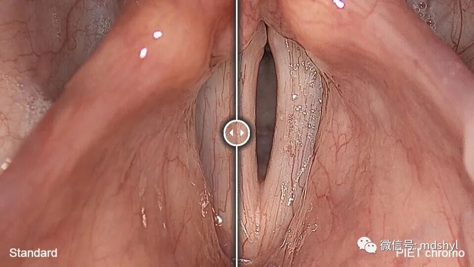 普通喉镜怎么使用如何避免动态电子喉镜误当普通电子喉镜使用？_https://www.jmylbn.com_新闻资讯_第19张