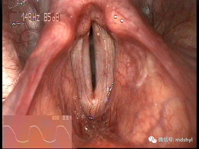 普通喉镜怎么使用如何避免动态电子喉镜误当普通电子喉镜使用？_https://www.jmylbn.com_新闻资讯_第22张