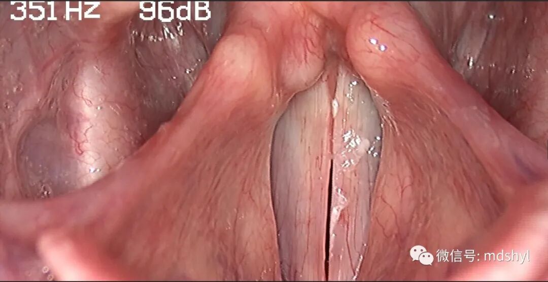 普通喉镜怎么使用如何避免动态电子喉镜误当普通电子喉镜使用？_https://www.jmylbn.com_新闻资讯_第20张