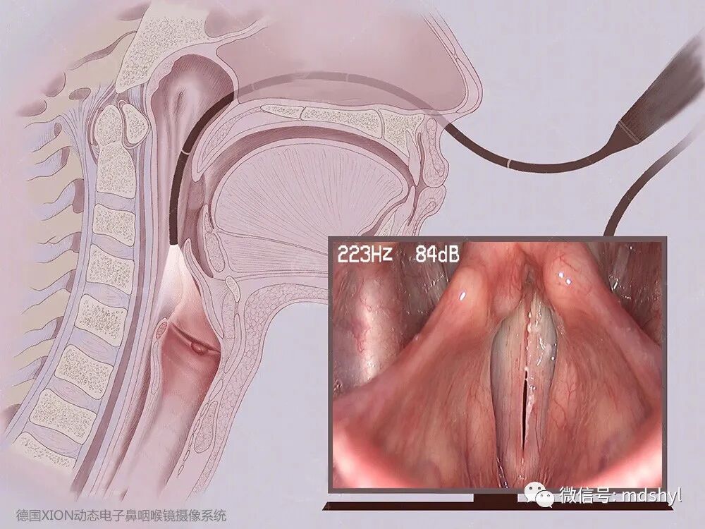 普通喉镜怎么使用如何避免动态电子喉镜误当普通电子喉镜使用？_https://www.jmylbn.com_新闻资讯_第41张