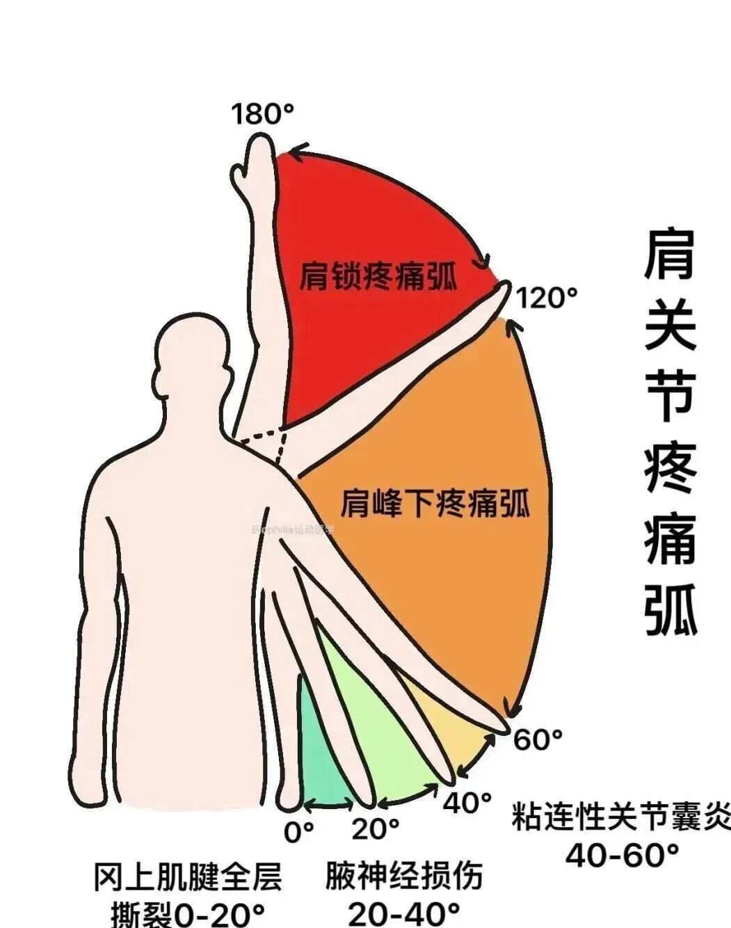 中频为什么能镇痛肩周炎（冻结肩）的综合诊疗思路_https://www.jmylbn.com_新闻资讯_第15张