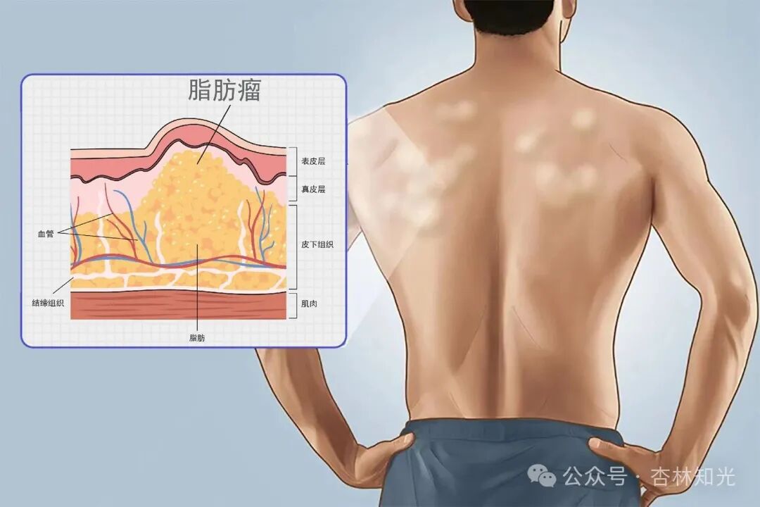 脂肪瘤方，我用了几十年，效果出众，送给有缘人！