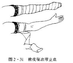 为什么要结扎血管止血技术_https://www.jmylbn.com_新闻资讯_第6张
