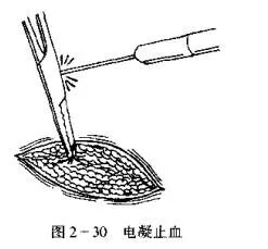 为什么要结扎血管止血技术_https://www.jmylbn.com_新闻资讯_第5张