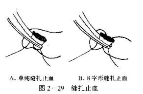 为什么要结扎血管止血技术_https://www.jmylbn.com_新闻资讯_第4张