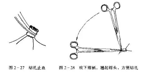 为什么要结扎血管止血技术_https://www.jmylbn.com_新闻资讯_第3张