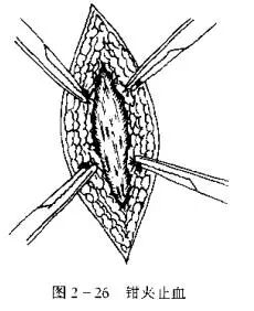 为什么要结扎血管止血技术_https://www.jmylbn.com_新闻资讯_第2张