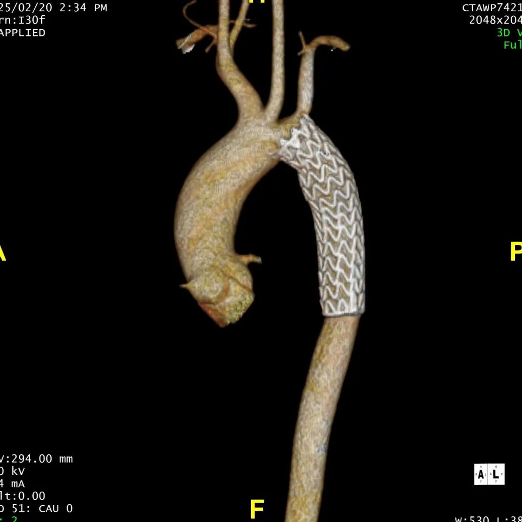 gore医疗怎么样「胸有乾坤」仁心仁术 精益求精——GORE® TAG® 可主动调控胸主动脉覆膜支架治疗15岁患者外伤后夹层病例报道_https://www.jmylbn.com_新闻资讯_第17张