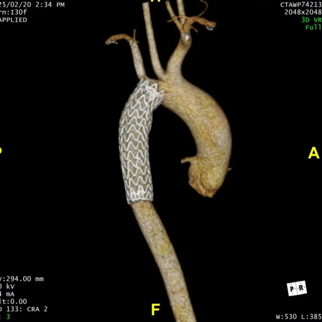 gore医疗怎么样「胸有乾坤」仁心仁术 精益求精——GORE® TAG® 可主动调控胸主动脉覆膜支架治疗15岁患者外伤后夹层病例报道_https://www.jmylbn.com_新闻资讯_第16张