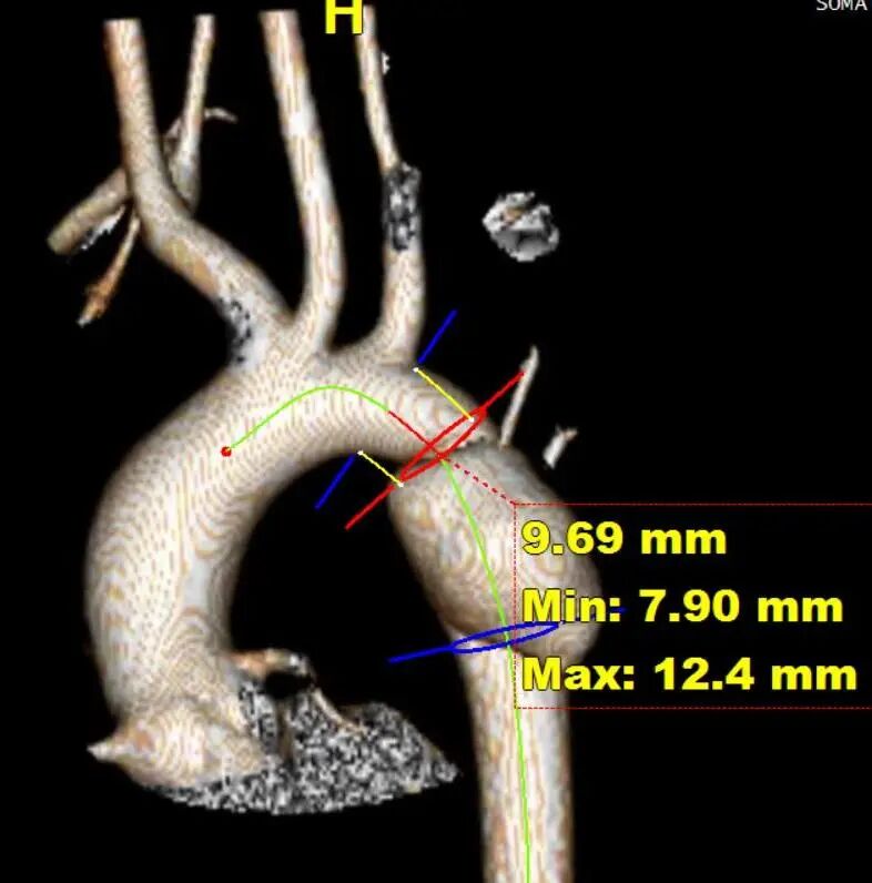 gore医疗怎么样「胸有乾坤」仁心仁术 精益求精——GORE® TAG® 可主动调控胸主动脉覆膜支架治疗15岁患者外伤后夹层病例报道_https://www.jmylbn.com_新闻资讯_第8张