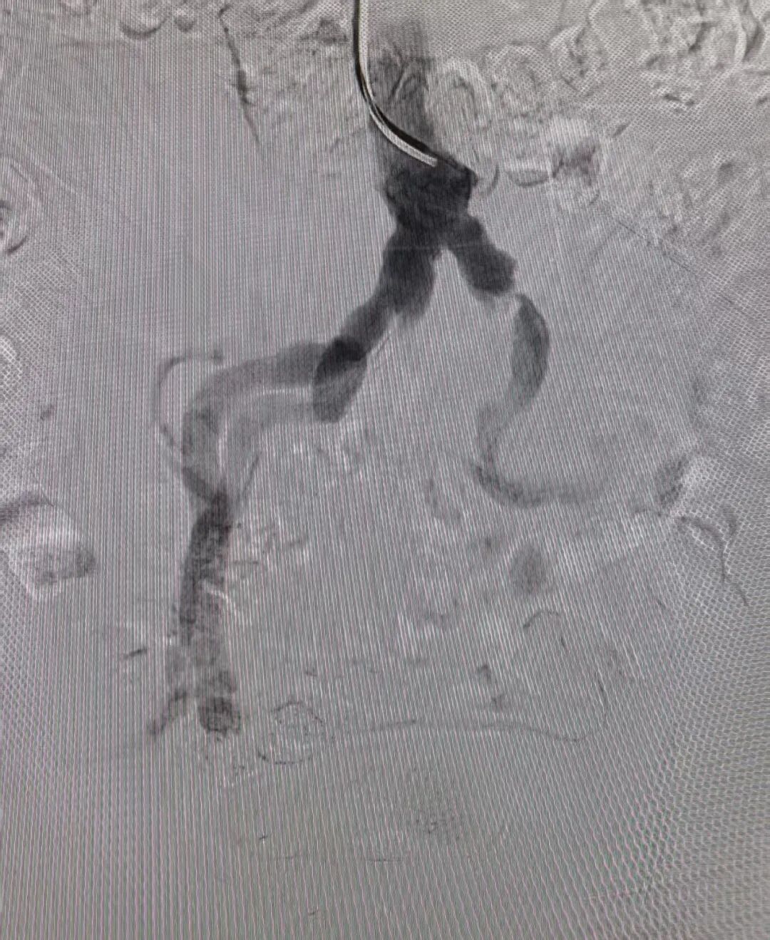 动脉长鞘怎么置入桡胜一筹丨吴巍巍主任、赵俊来教授团队：应用Brite Tip RADIANZ长鞘经桡动脉治疗下肢动脉粥样硬化闭塞症一例_https://www.jmylbn.com_新闻资讯_第16张