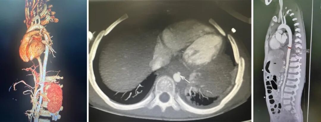 gore医疗怎么样How I Do It ｜ 张雷杨教授团队：Gore VBX用于儿童主动脉食管瘘治疗一例分享_https://www.jmylbn.com_新闻资讯_第3张