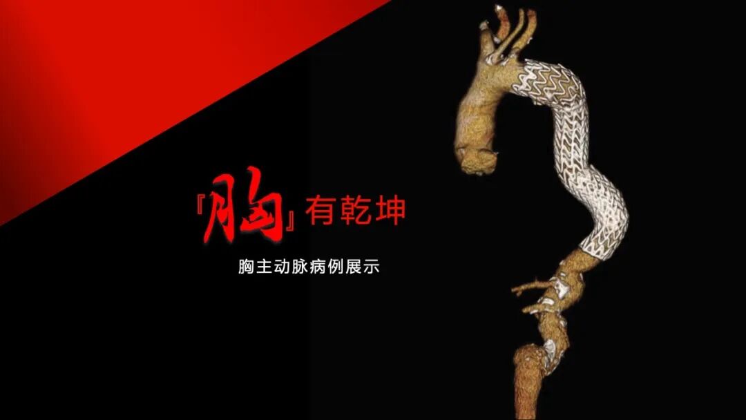 gore医疗怎么样「胸有乾坤」可调可控 遂心应手——GORE® TAG® 可主动调控胸主动脉覆膜支架治疗急性夹层病例报道_https://www.jmylbn.com_新闻资讯_第2张