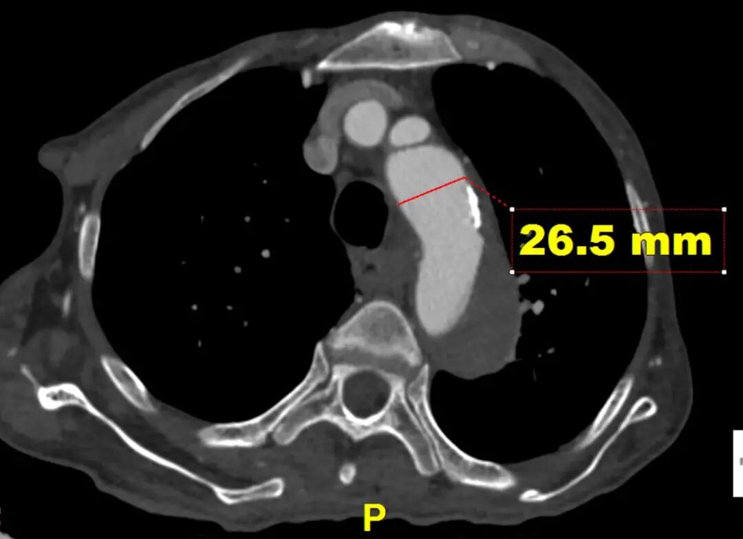 gore医疗怎么样「胸有乾坤」可调可控 遂心应手——GORE® TAG® 可主动调控胸主动脉覆膜支架治疗急性夹层病例报道_https://www.jmylbn.com_新闻资讯_第10张