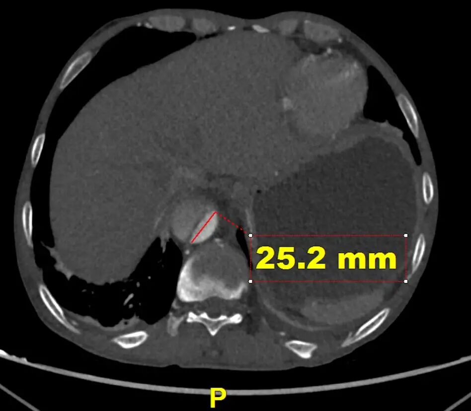 gore医疗怎么样「胸有乾坤」可调可控 遂心应手——GORE® TAG® 可主动调控胸主动脉覆膜支架治疗急性夹层病例报道_https://www.jmylbn.com_新闻资讯_第9张