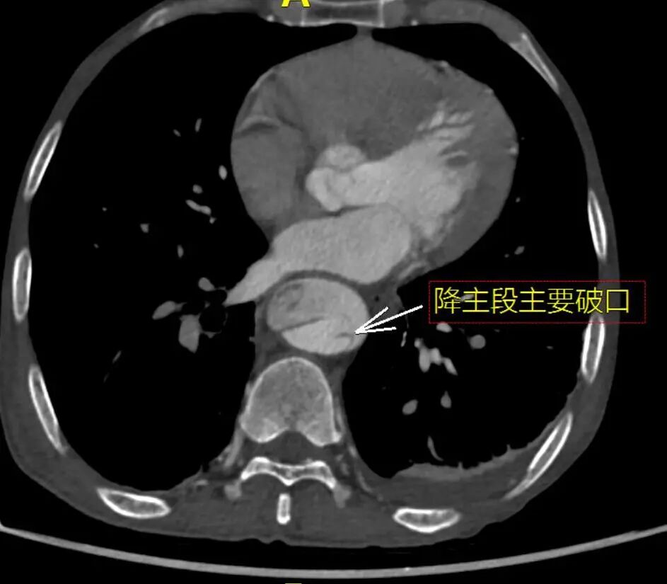 gore医疗怎么样「胸有乾坤」可调可控 遂心应手——GORE® TAG® 可主动调控胸主动脉覆膜支架治疗急性夹层病例报道_https://www.jmylbn.com_新闻资讯_第8张