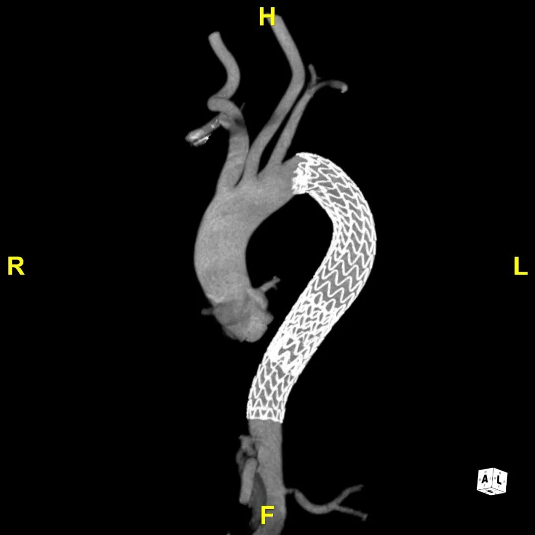 gore医疗怎么样「胸有乾坤」可调可控 遂心应手——GORE® TAG® 可主动调控胸主动脉覆膜支架治疗急性夹层病例报道_https://www.jmylbn.com_新闻资讯_第20张