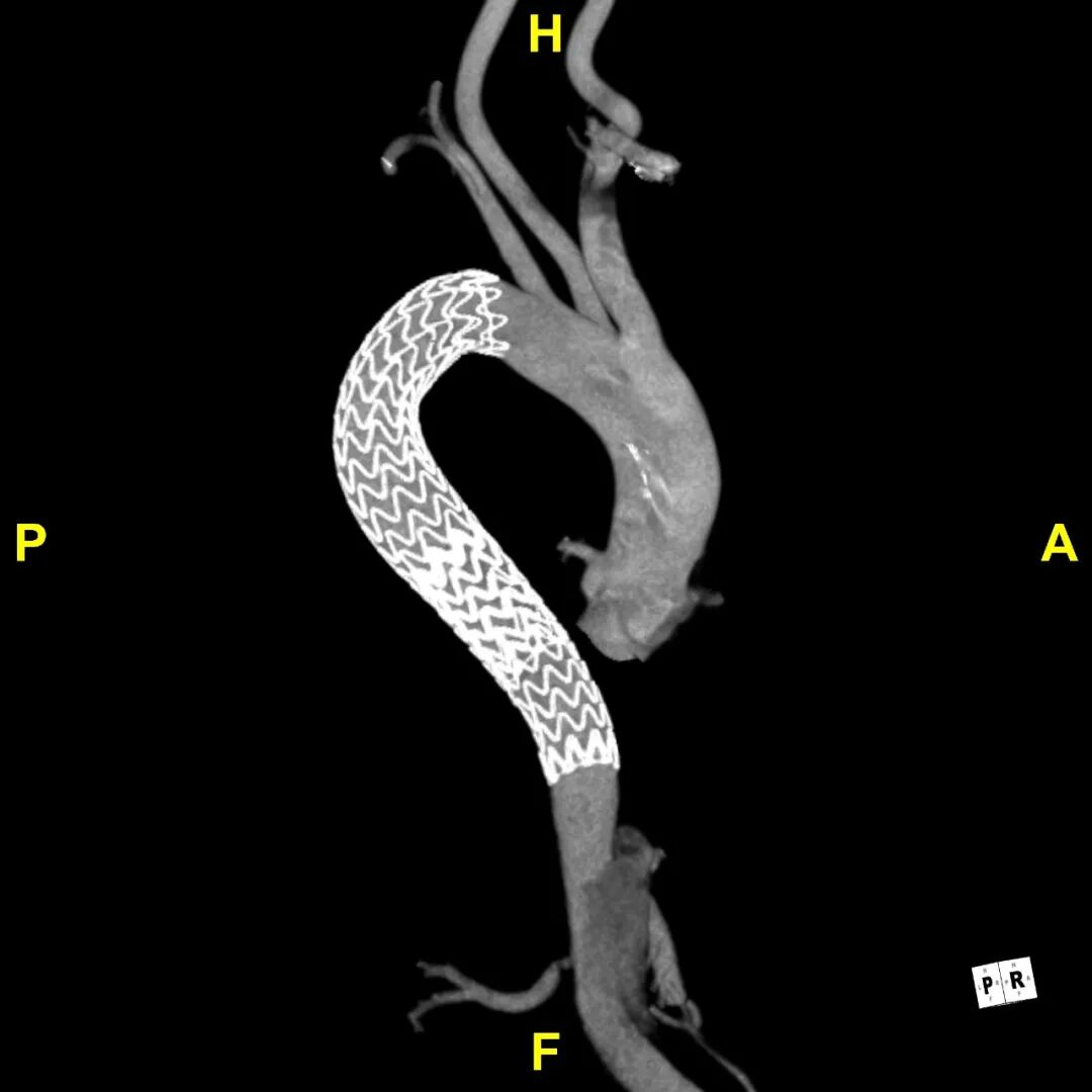 gore医疗怎么样「胸有乾坤」可调可控 遂心应手——GORE® TAG® 可主动调控胸主动脉覆膜支架治疗急性夹层病例报道_https://www.jmylbn.com_新闻资讯_第21张