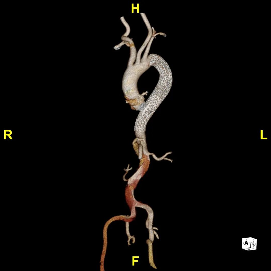 gore医疗怎么样「胸有乾坤」可调可控 遂心应手——GORE® TAG® 可主动调控胸主动脉覆膜支架治疗急性夹层病例报道_https://www.jmylbn.com_新闻资讯_第18张