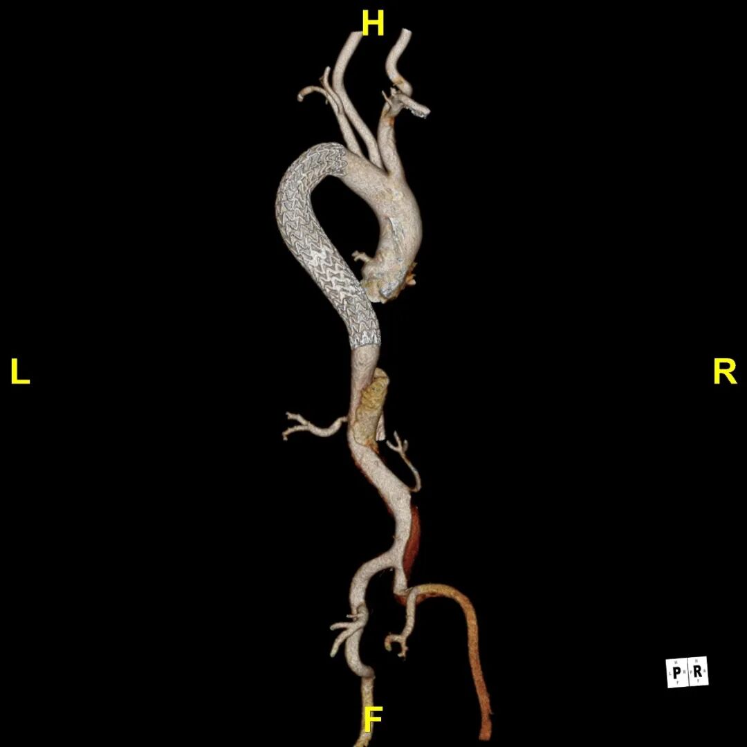 gore医疗怎么样「胸有乾坤」可调可控 遂心应手——GORE® TAG® 可主动调控胸主动脉覆膜支架治疗急性夹层病例报道_https://www.jmylbn.com_新闻资讯_第19张