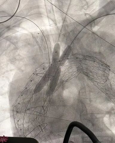 gore医疗怎么样「胸有乾坤」强弓硬弩 一蹴而就——CTAG弓上三开窗治疗主动脉夹层病例报道_https://www.jmylbn.com_新闻资讯_第15张