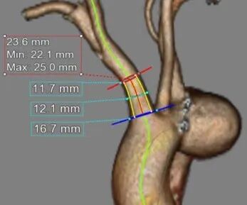 斑马导丝是治疗什么的「胸有乾坤」至简至易 行之有效—— Zone 0 TBE植入治疗弓部动脉瘤病例报道_https://www.jmylbn.com_新闻资讯_第9张