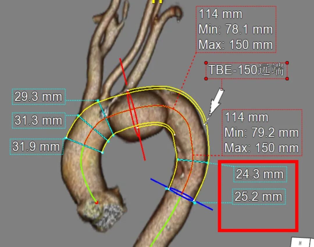 斑马导丝是治疗什么的「胸有乾坤」至简至易 行之有效—— Zone 0 TBE植入治疗弓部动脉瘤病例报道_https://www.jmylbn.com_新闻资讯_第10张
