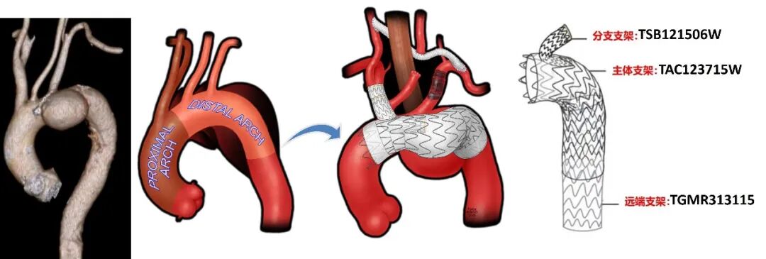 斑马导丝是治疗什么的「胸有乾坤」至简至易 行之有效—— Zone 0 TBE植入治疗弓部动脉瘤病例报道_https://www.jmylbn.com_新闻资讯_第12张