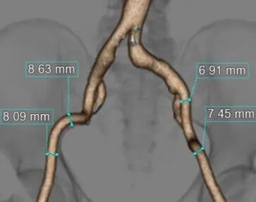 斑马导丝是治疗什么的「胸有乾坤」至简至易 行之有效—— Zone 0 TBE植入治疗弓部动脉瘤病例报道_https://www.jmylbn.com_新闻资讯_第11张
